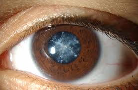 Cataract: types, risks, symptoms and causes associated with it